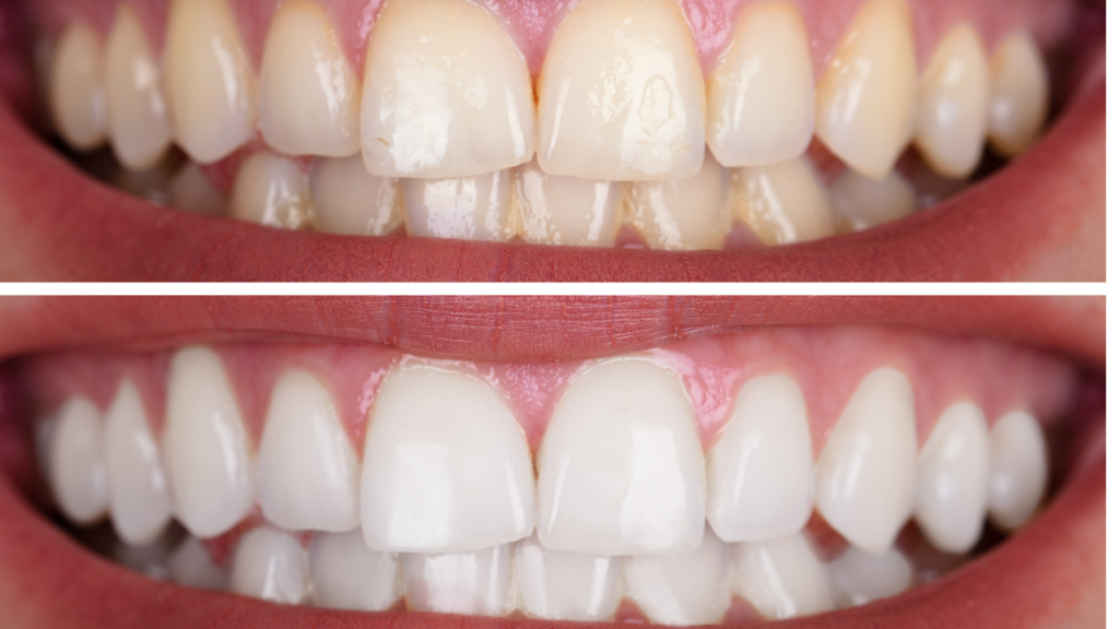 Piaskowanie zębów to niezwykła i szybka metamorfoza